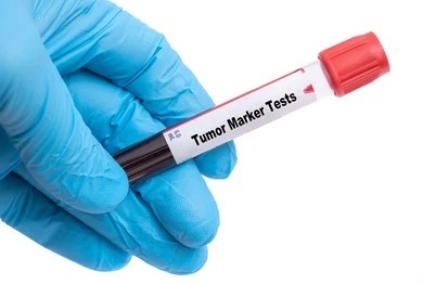 Tumor Markers in Cancer