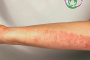 ITP - Immune Thrombocytopenia (Immune Thrombocytopenic Purpura)